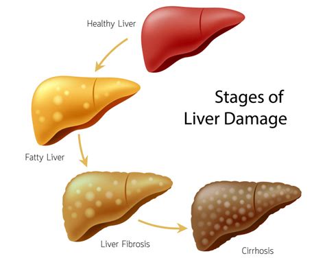 I was diagnosed with fatty liver disease. What is it, and is this ...