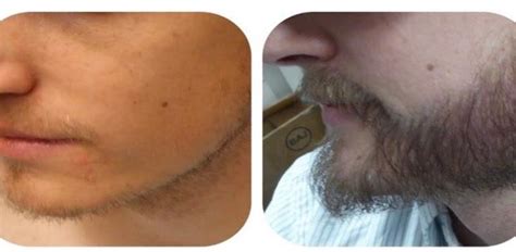 Beard Hair Transplant | Hair Restoration Specialists & Aesthetics ...