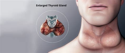 Multinodular Goitre: Overview & Treatment