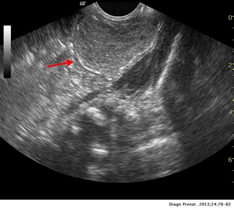 Solid appearing abdominal mass in the foetus: A diagnostic dilemma | Diagnóstico Prenatal