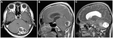 Frontiers | Intraparenchymal cerebellar capillary hemangioma in a 32-year-old man: a case report