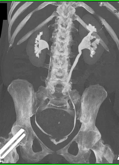 Staghorn Calculi Left Kidney - Kidney Case Studies - CTisus CT Scanning