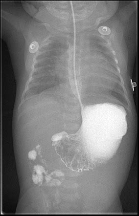 Intestinal malrotation | Radiology Case | Radiopaedia.org