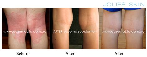 Eczema treatments before and after | Eczema Life