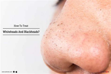 How To Treat Whiteheads And Blackheads? - By Dr. Rajeshwari K A Bhat ...