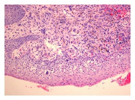 Definitive histological examination showing a carcinosarcoma with ...