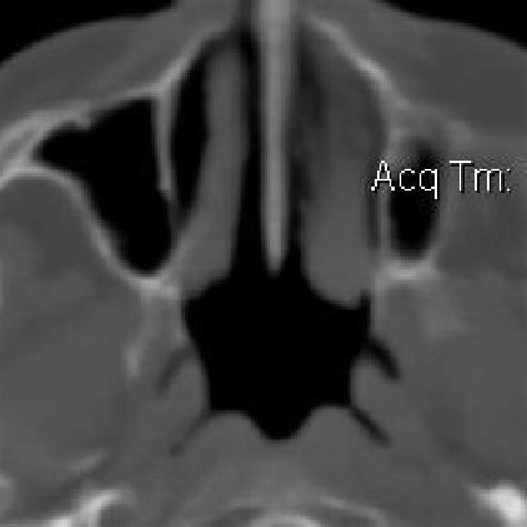 hypoplasia of the left maxillary sinus. | Download Scientific Diagram