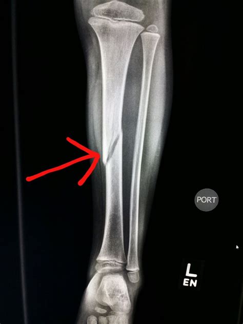 Leg Fracture X Ray