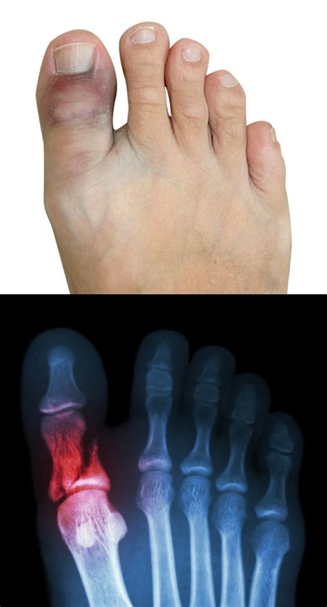 Sprained Big Toe vs. Broken Big Toe: Causes, Symptoms & How to Treat