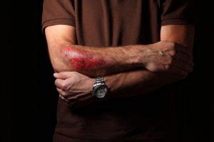 How to treat road rash after a motorcycle accident