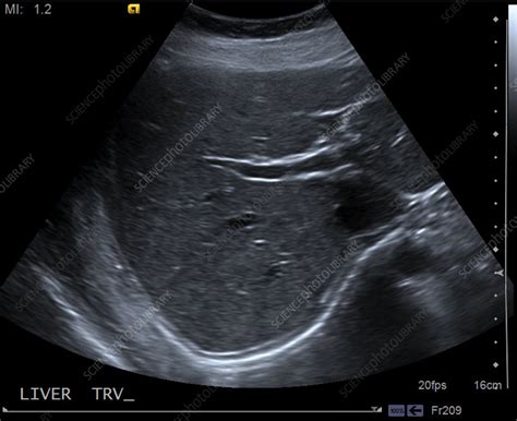 Normal Liver Ultrasound