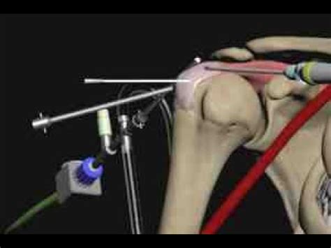 Rotator Cuff Repair (supraspinatus tear) Animation by Cal Shipley, M.D. - YouTube