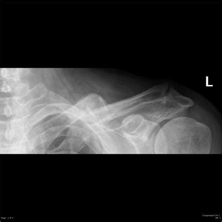 Clavicular fracture | Radiology Reference Article | Radiopaedia.org