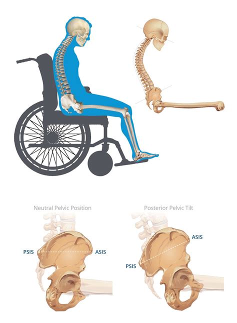 Posterior Pelvic Tilt: The Correction of Sacral Sitting