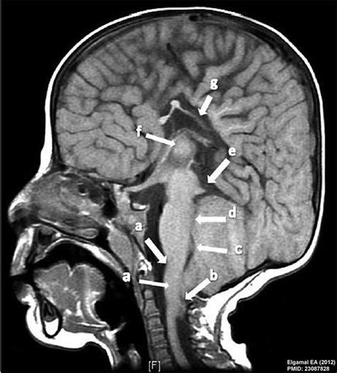 File:Chiari II malformation MRI01.jpg - Embryology