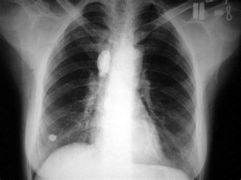 Pulmonary Tuberculosis and PPD - Infectious Dis. - Medbullets Step 2/3