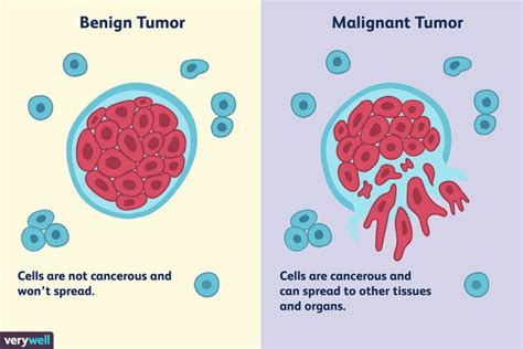 Differences Between a Malignant and Benign Tumor | Malignant tumor ...