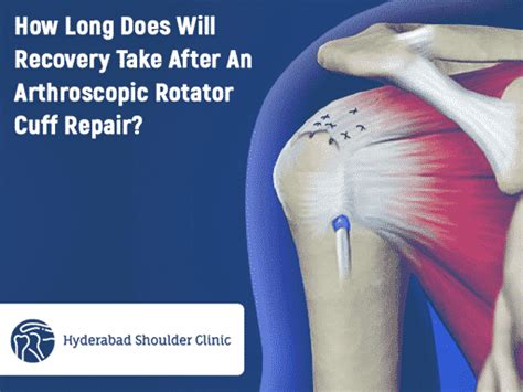 Rotator Cuff Tears - shoulder clinic Hyderabad