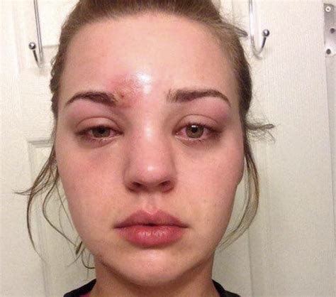 Young Woman Pops A 'Pimple' Above Eye, Then Staph Infection Almost Blinds Her - Relay Hero