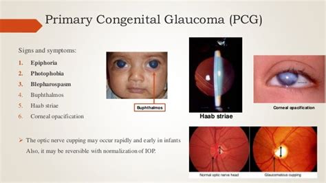 Congenital Glaucoma