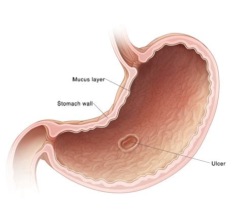 StStomach and Duodenal Ulcers - CHOC Children's, Orange County