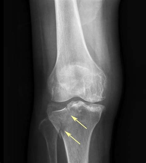 RiT radiology: Tibial Plateau Fracture