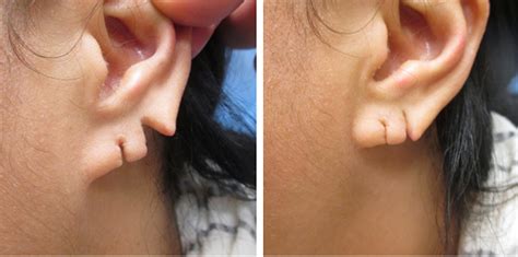 Ripped Earlobe Repair