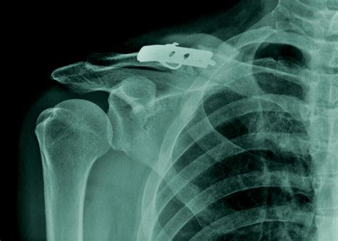 Clavicle Fracture Repair | Orthopedic Shoulder Surgeon | Vail, Aspen, Denver, Colorado