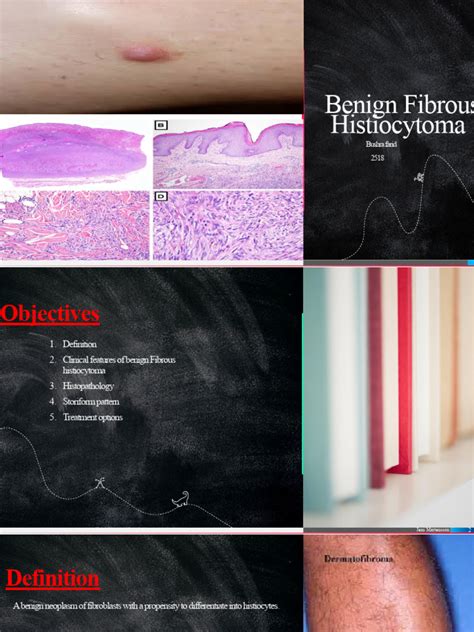 Benign Fibrous Histiocytoma | PDF | Connective Tissue | Benign Tumor