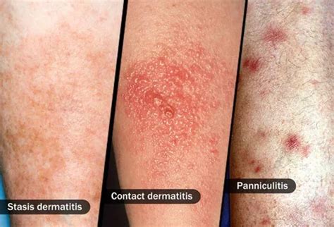 Cellulitis: Pictures of Causes, Symptoms, and Treatments