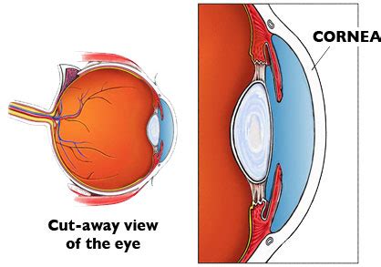 Cornea Specialists, Cornea Conditions & Treatments | ICON Eyecare Grand ...