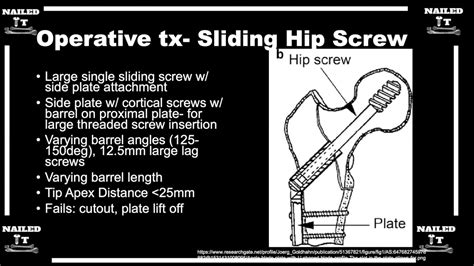 Dynamic Sliding Hip Screw Device Explained Clearly w/ Dr. Sanders ...