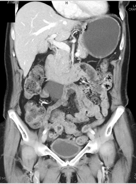 Mesenteric Cyst - Gastrointestinal Case Studies - CTisus CT Scanning