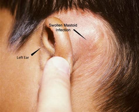 Middle Ear Infection Images | McGovern Medical School