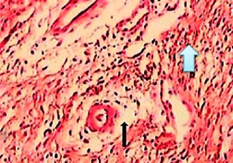 Tendon of suture group, 2 months post-surgery show inflammatory cells... | Download Scientific ...