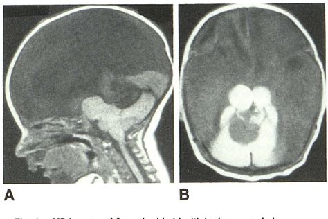 Figure 1 from MR of hydranencephaly. | Semantic Scholar