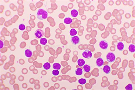 Acute Lymphocytic Leukemia or ALL Cells in Blood Smear Stock Photo - Image of disease, leukemia ...