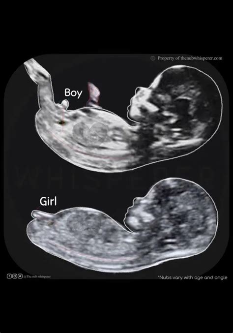 Your First Ultrasound Can Tell The Gender Of Your Baby? - Ur Baby Blog