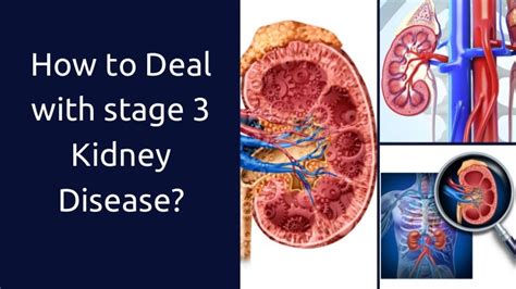 How to Deal with Stage 3 Kidney Disease