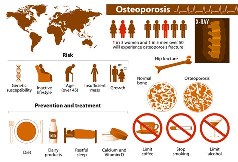 Bone density: what do we need to know about Osteoporosis? - Chiropractic Dubai