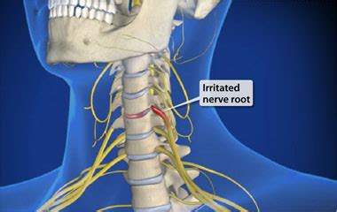 Cervical Radiculopathy Treatment And Assessment | The Prehab Guys