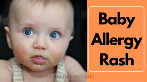 Food Allergy Skin Rash Baby