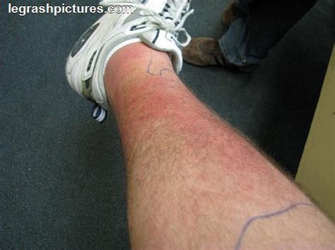 diabetes rashes on legs - pictures, photos