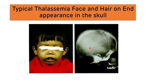 Beta Thalassemia Chipmunk Face