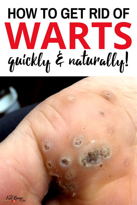 Best Home Remedies To Get Rid of Warts