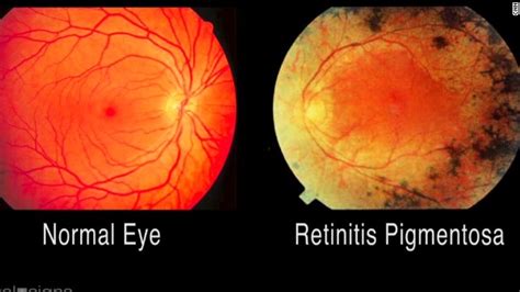 Retinitis pigmentosa; Pigmentary Retinopathy; Rod-Cone Dystrophy; Tapetoretinal Degeneration