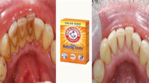 How to Remove Plaque & Tartar from Teeth with Baking Soda at Home Realtime YouTube Live View ...