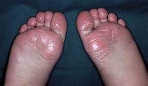 How is juvenile plantar dermatosis treated