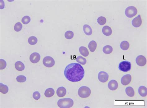 Lymphoblast