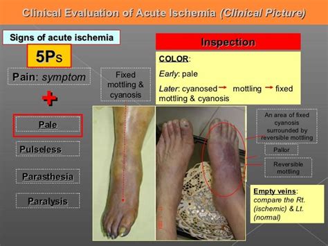 ACUTE LIMB ISCHEMIA,MANAGEMENT